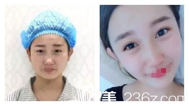 邢臺(tái)博愛雙眼皮案例