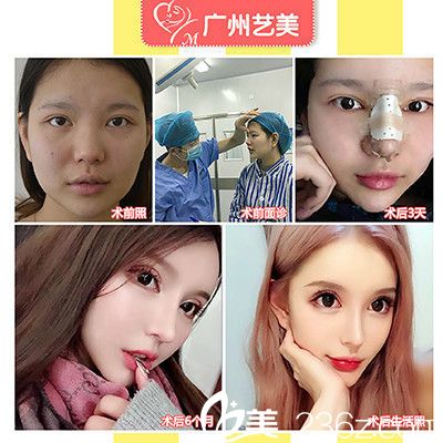 廣州藝美李闖院長做的李氏3C翹鼻術案例