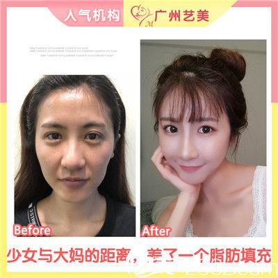 廣州藝美李闖院長做的自體脂肪面部填充案例