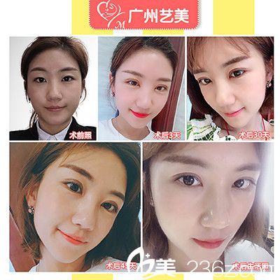 廣州藝美張濤院長做的切開雙眼皮案例