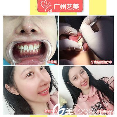 廣州藝美袁媛做的牙貼面真人案例