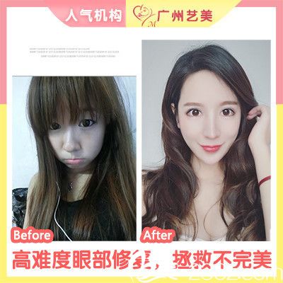 廣州藝美張濤院長做的雙眼皮失敗修復案例