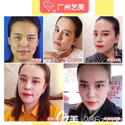 廣州藝美張濤院長面部<span style=