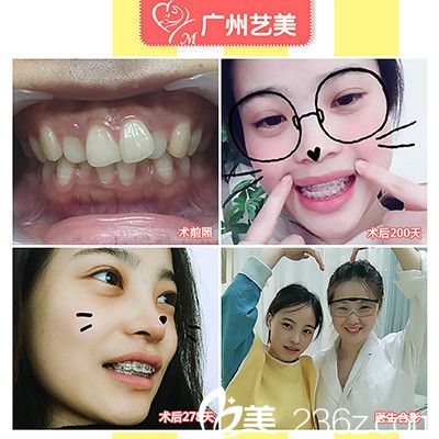 廣州藝美袁媛主任做的牙齒矯正案例