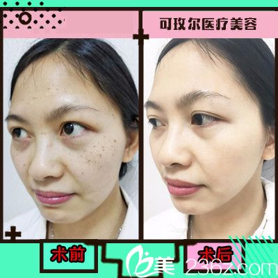 廣州可玫爾醫(yī)療美容整形醫(yī)院超皮秒祛斑 廣州可玫爾醫(yī)療美容整形醫(yī)院超皮秒祛斑