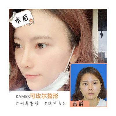 廣州可玫爾整形醫(yī)院張球俊做的隆鼻 廣州可玫爾整形醫(yī)院張球俊做的隆鼻