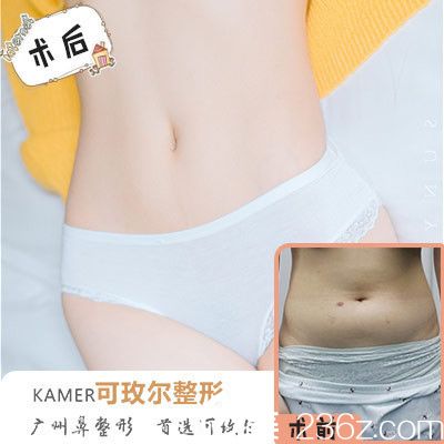 廣州可玫爾整形醫(yī)院<!--<i data=20240703-sp></i>-->誠做的吸脂 廣州可玫爾整形醫(yī)院<!--<i data=20240703-sp></i>-->誠做的吸脂