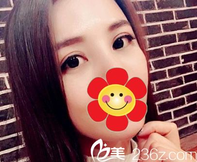 眼霜和手術(shù)去眼袋哪個好 ?我在呼和浩特紫潔整形做的是超聲波去眼袋