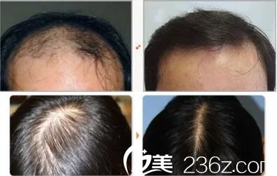 毛發(fā)移植真人案例前后效果對(duì)比 毛發(fā)移植真人案例前后效果對(duì)比