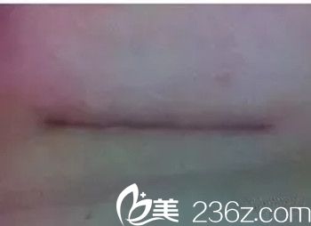 5.webp.jpg 乳房下皺襞切口 5.webp.jpg 乳房下皺襞切口