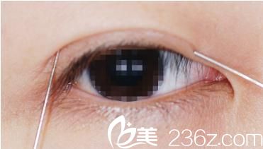 埋線術(shù)前 埋線術(shù)前