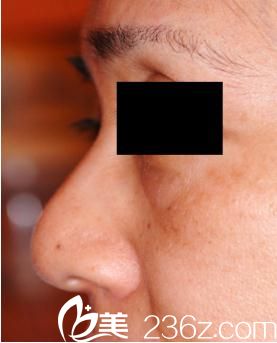 隆鼻術(shù)前 隆鼻術(shù)前