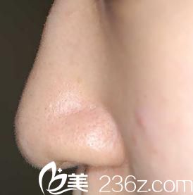 鼻尖形成術(shù)前 鼻尖形成術(shù)前