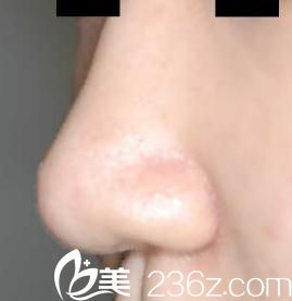 鼻尖形成術(shù)后 鼻尖形成術(shù)后