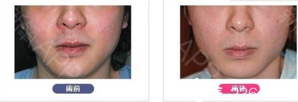 面部輪廓整形削下巴 面部輪廓整形削下巴