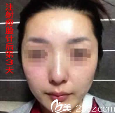 我在運城華美打瘦臉后第3天照片 我在運城華美打瘦臉后第3天照片