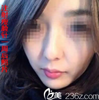 我在運城華美注射瘦臉后一周照片 我在運城華美注射瘦臉后一周照片