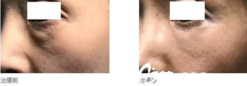 眼部高見式玻尿酸注射 眼部高見式玻尿酸注射