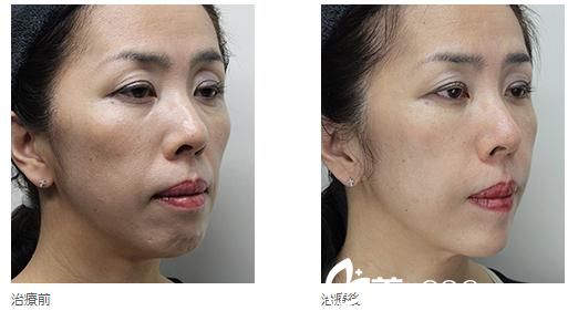 全臉高見式玻尿酸注射 全臉高見式玻尿酸注射