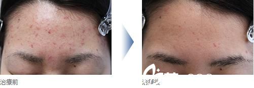 額頭粉刺治療 額頭粉刺治療