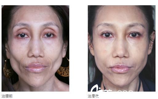 高見式玻尿酸注入 高見式玻尿酸注入