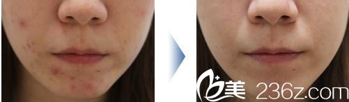 面部下部粉刺治療 面部下部粉刺治療
