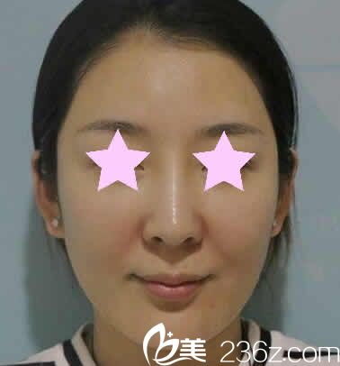 我在聊城韓美整形做全臉線雕提升前照片 我在聊城韓美整形做全臉線雕提升前照片