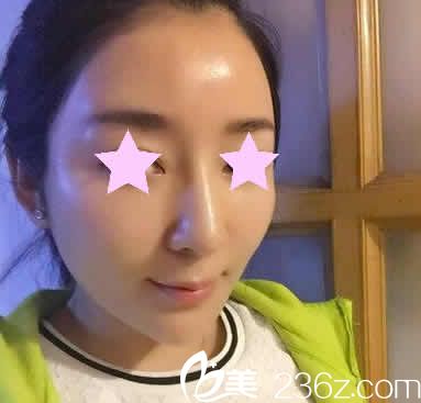 我在聊城韓美整形做線雕提升后第3天照片 我在聊城韓美整形做線雕提升后第3天照片