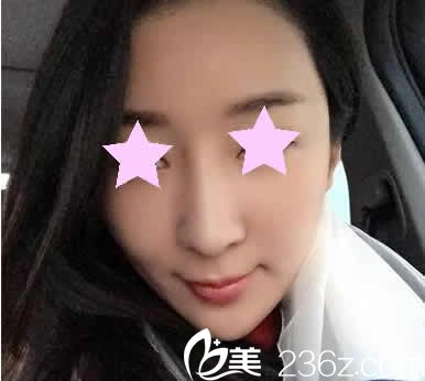  透露一下我在聊城韓美整形做全臉線雕提升前后對比照片和親身經(jīng)歷