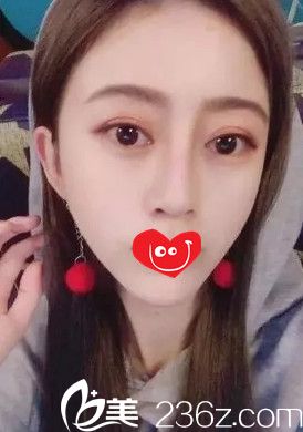 喜歡歐美范的小仙女可以參考我找陳逸華醫(yī)生做的假體隆鼻案例