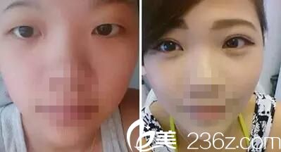 荊門和麗雙眼皮案例 荊門和麗雙眼皮案例
