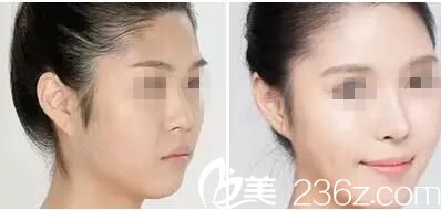 荊門和麗隆鼻案例 荊門和麗隆鼻案例