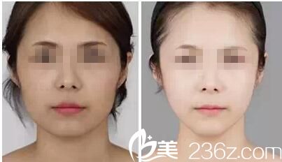 荊門和麗瘦臉案例 荊門和麗瘦臉案例