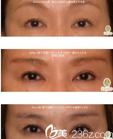 眉下切開術(shù)