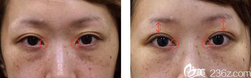 埋設(shè)法雙眼皮