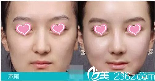 青?？等A隆鼻案例