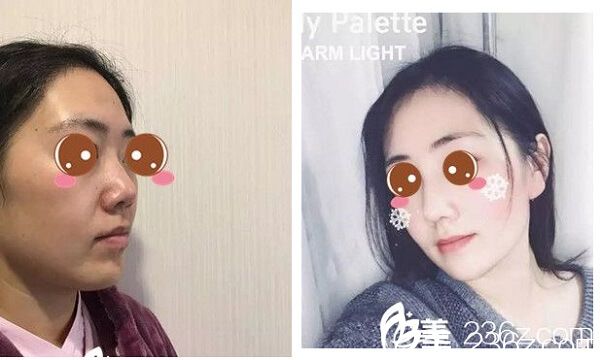 西寧時(shí)光隆鼻案例