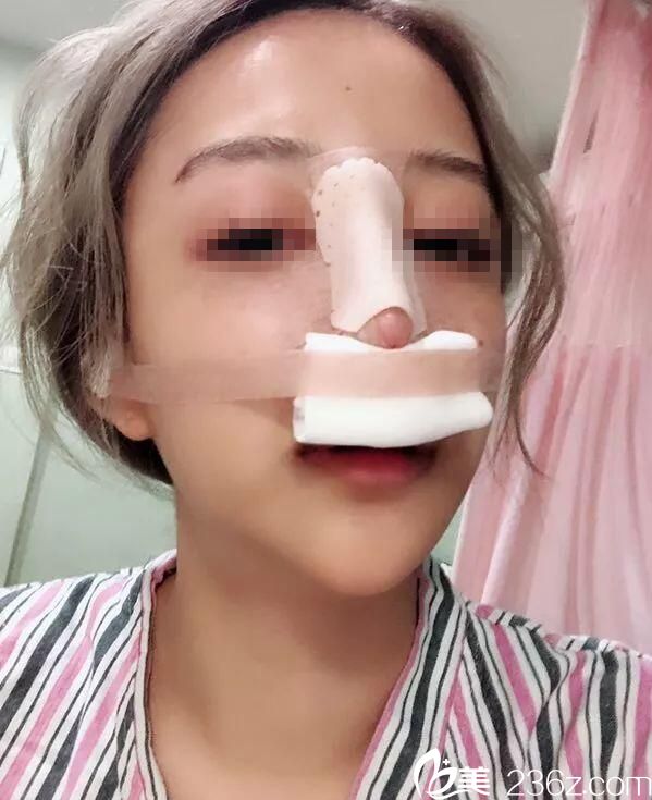 鼻綜合術(shù)后即刻效果 鼻綜合術(shù)后即刻效果