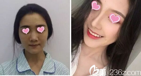 西寧夏都隆鼻案例