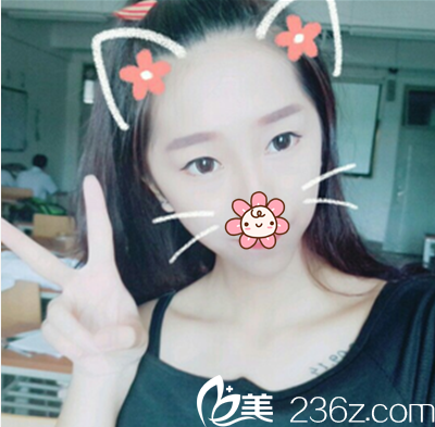 平行雙眼皮術(shù)前照片 平行雙眼皮術(shù)前照片