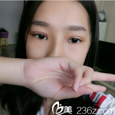 樂山達(dá)芬奇雙眼皮術(shù)后即刻 樂山達(dá)芬奇雙眼皮術(shù)后即刻