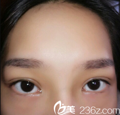 平行雙眼皮術(shù)后半個(gè)月恢復(fù)情況 平行雙眼皮術(shù)后半個(gè)月恢復(fù)情況