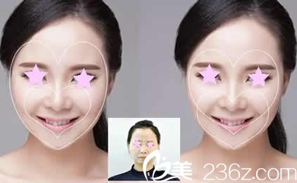 太原華美整形特邀醫(yī)生呂睿紘雙心臉案例圖