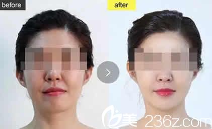 太原華美整形醫(yī)生呂睿紘面部埋線提升案例圖