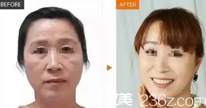 呂睿紘微創(chuàng)面部注射年輕化效果圖