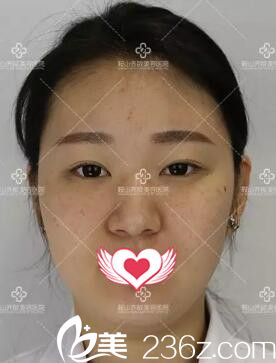 做玻尿酸隆鼻+隆下巴術(shù)前照片 做玻尿酸隆鼻+隆下巴術(shù)前照片