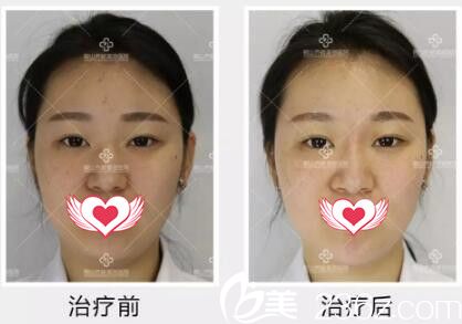 玻尿酸隆鼻+隆下巴術(shù)前術(shù)后<span style= 玻尿酸隆鼻+隆下巴術(shù)前術(shù)后<span style=