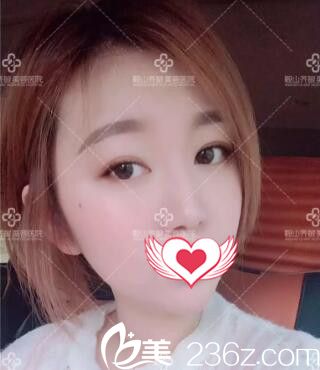 鞍山注射隆鼻哪家好？看我在鞍山整形醫(yī)院做玻尿酸隆鼻+隆下巴術(shù)后15天效果圖！