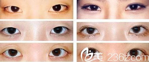 眼睛修復(fù)手術(shù)