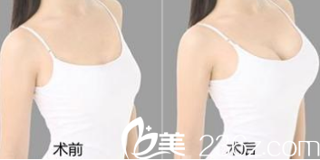 東營藝美假體隆胸真人<span style=